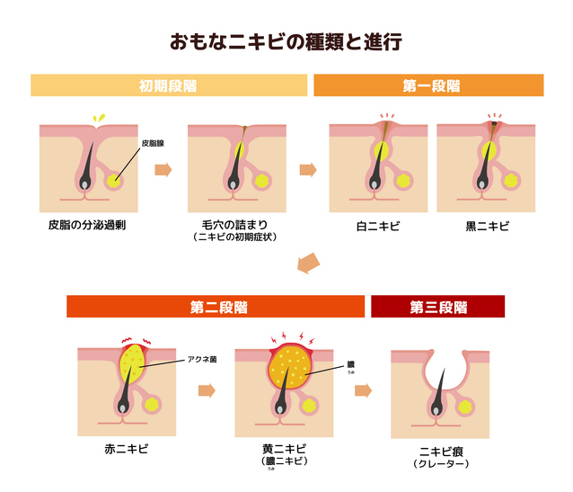 そもそもニキビになる原因は？